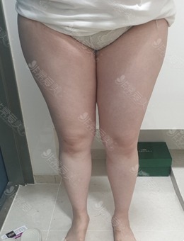 韩国梦线整形大腿臀部吸脂真人前后对比图分享