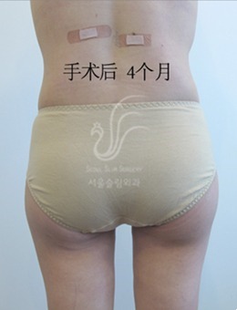 韩国首尔slim外科医院臀部赘皮切除手术前后对比照分享
