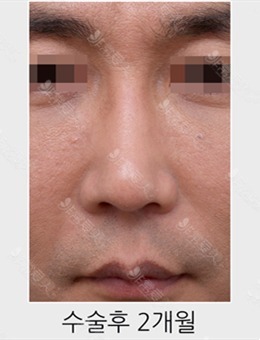 男士鼻修复前后对比图分享，苦等2个月终于变成正常人_术后