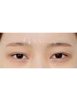 韩国JUST整形眼型矫正修复+眼角下置术前术后对比照分享！_术前