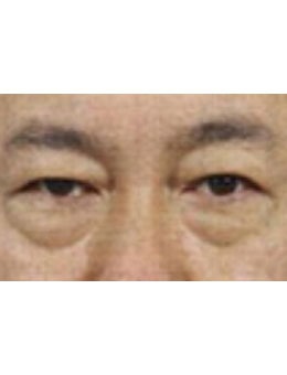韩国真实整形外科男士去眼袋手术前后对比_术前