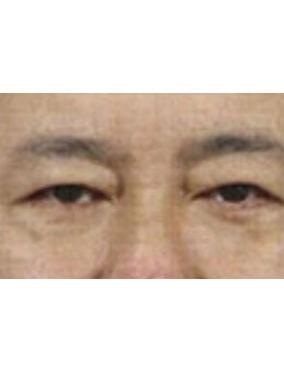 韩国真实整形外科男士去眼袋手术前后对比_术后