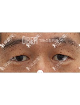 更新一组韩国玉芭uber整形上眼下垂矫正整形手术实例。_术前