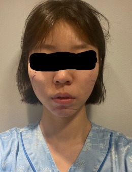 韩国立体整形外科轮廓三件套案例对比明显,下颌线超好看!_术前