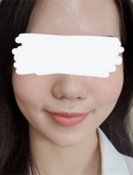 韩国IPCHEA立体整形外科鼻翼缩小术后第三天后记分享！_术后