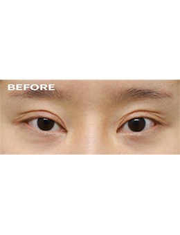 韩国双眼皮修复医院做上睑下垂矫正和宽改窄修复的效果太惊艳了！_术前