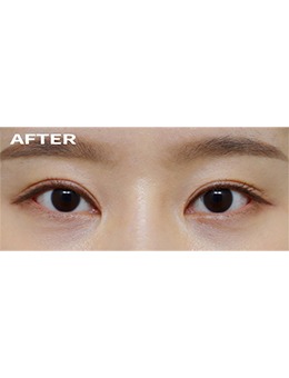 韩国双眼皮修复医院做上睑下垂矫正和宽改窄修复的效果太惊艳了！_术后