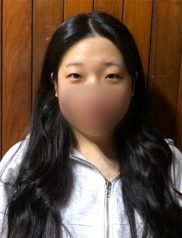 韩国朵医院埋线双眼皮+提肌，术后眼睛大变样！_术前