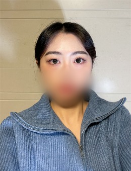 -韩国朵医院：双眼皮眼底脂肪重置前后对比，真的超惊艳~