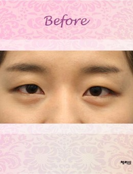 韩国CHERISH整形医院双眼皮整形效果分享