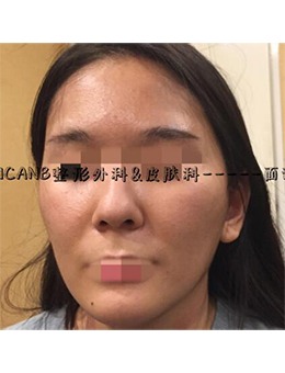 韩国Ucanb整形外科医院面部脂肪移植，年轻十岁不是梦！