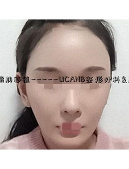 -韩国Ucanb整形外科医院面部脂肪移植，年轻十岁不是梦！