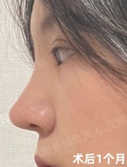 -在韩国德丽珍做了双眼皮+提肌+鼻整形手术，术后1个月很自然!