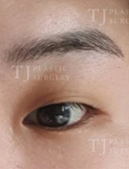 韩国TJ整形外科自然黏连双眼皮前后对比图片分享~_术前