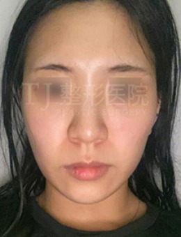 韩国TJ整形外科隆鼻+面部填充改善前后效果对比_术前