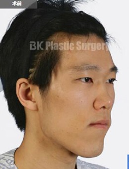 韩国BK整形医院-韩国BK整形医院下颚前突矫正手术