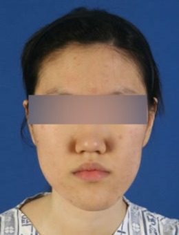 韩国BK整形外科下颚前突矫正对比照片
