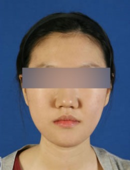 韩国BK整形外科下颚前突矫正对比照片_术后