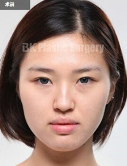 韩国BK整形外科颜面轮廓整形案例图_术前