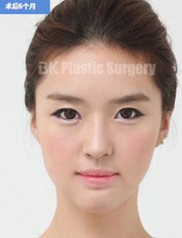 韩国BK整形医院-韩国BK整形外科颜面轮廓整形案例图