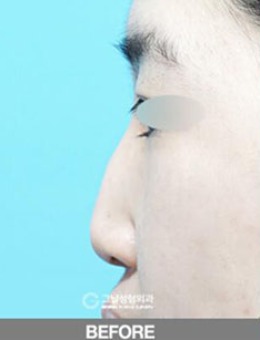 -韩国歌娜整形外科矮鼻矫正，做失败的鼻子轻松恢复变好看！