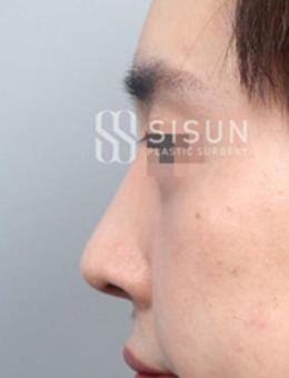 韩国sisun视线整形外科鹰钩鼻改善，真人前后对比照片展示！