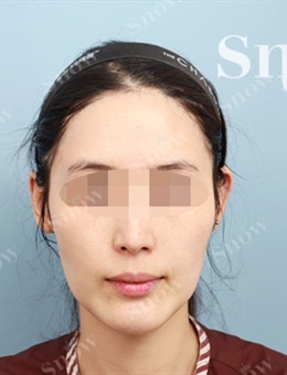 韩国SNOW整形外科全脸脂肪填充+嘴角颧骨吸脂案例_术前