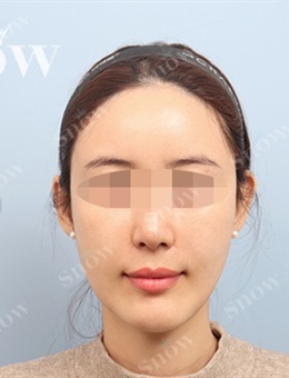 -韩国SNOW整形外科全脸脂肪填充+嘴角颧骨吸脂案例