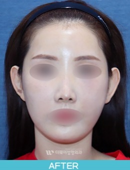 韩国TheWAY整形医院自体脂肪填充全脸对比