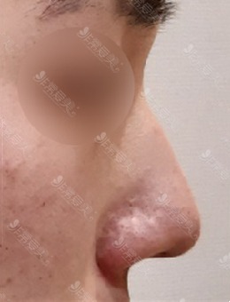 有不用假体的鼻整形哦，一组不放假体的鼻综合真实图片分享_术前