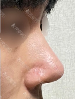 有不用假体的鼻整形哦，一组不放假体的鼻综合真实图片分享