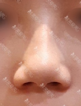 无假体隆鼻疗效是真的好，无假体隆鼻前后对比图男公布~_术前