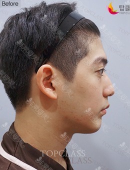 韩国TopClass整形外科医院男士鼻子整形前后照片分享~_术前