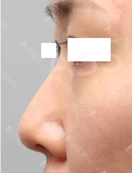 -韩国人做的鼻子太自然了，这组鼻综合手术前后对比照片就是证据