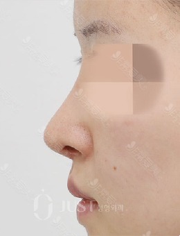 鼻子塌和朝天鼻怎么整？朝天鼻塌鼻梁做鼻综合多角度图片分享_术后