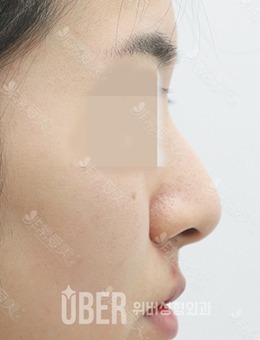 韩国玉芭无假体隆鼻+鼻翼缩小前后对比图分享，疗效靠谱！_术前