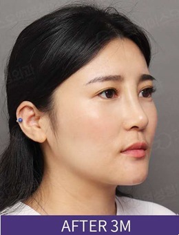 韩国格瑞丝噢爱美整形外科眼鼻综合+瘦脸针真人案例