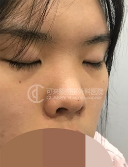 -韩国可来熙整形外科鼻综合+宽鼻缩小手术前后各角度效果图分享