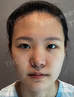 -韩国德丽珍整形外科眼鼻整形都厉害,不信来看看案例对比!