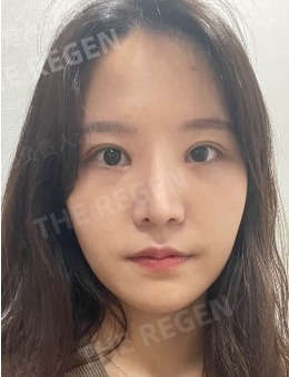 韩国德丽珍整形外科眼鼻整形都厉害,不信来看看案例对比!