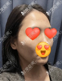 -韩国1%整形3D颧骨缩小术+双下巴溶脂提升+脂肪填充术，完美脸型你也可以拥有！