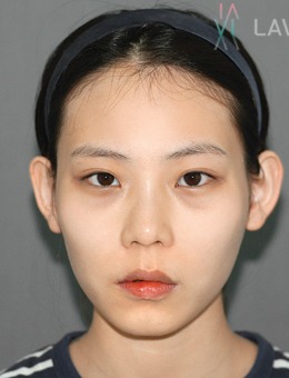 韩国拉菲安整形外科面部轮廓综合整形案例_术前