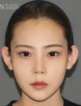 韩国拉菲安整形-韩国拉菲安整形外科面部轮廓综合整形案例
