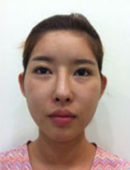 韩国绮林整形外科-她在绮林整形做面部轮廓手术的前后变化