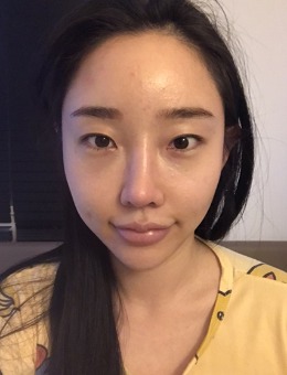 韩国面部轮廓手术哪家技术好？拉菲安整形磨骨很厉害!