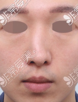 韩国歪鼻整形比较好的医院星整形外科矫正前后图片！