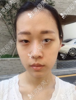 韩国脸本脸骨全面部整形恢复过程图 看看他们家风格你喜欢吗？_术前