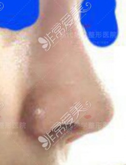韩国现代美学整形医院男士鼻整形前后图分享！