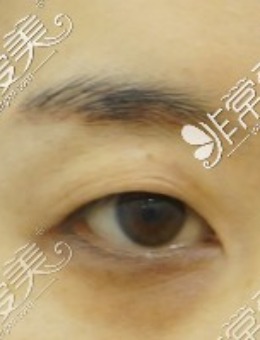 -韩国MIHO整形切割提肌眼部整形手术实例分享！