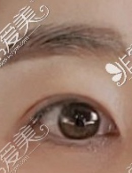 韩国MIHO整形切割提肌眼部整形手术实例分享！